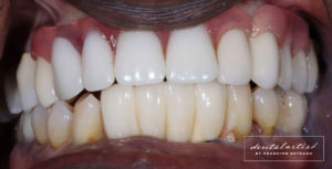 Sonelius Smith's teeth, after a partial that replaced his four front teeth. His new front teeth are straight and white.