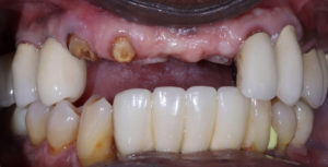 The teeth of Sonelius Smith before the partial denture that replaced his four front teeth, which broke at the gum line.